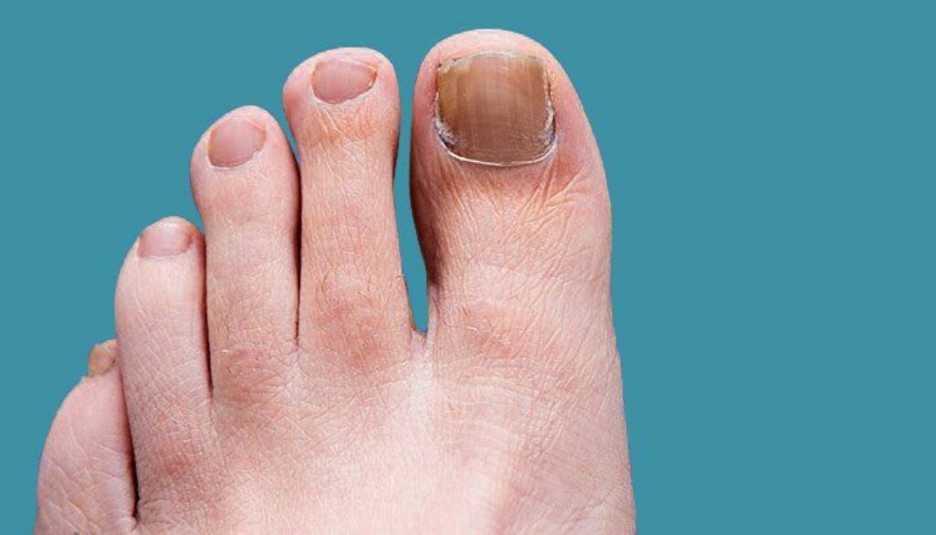 How to Prevent and Treat Nail Fungus