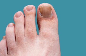 How to Prevent and Treat Nail Fungus