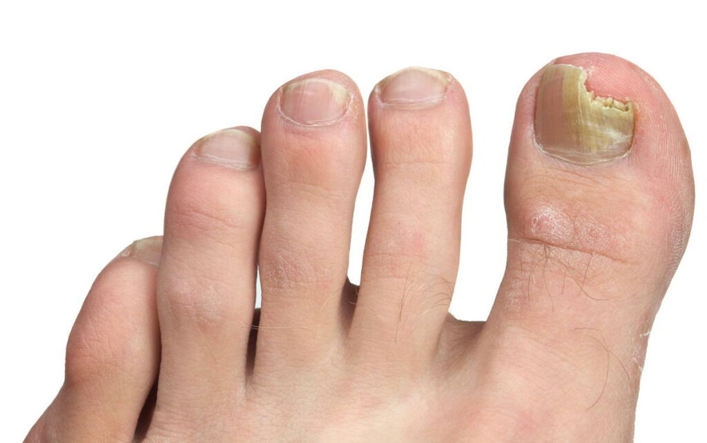 How to Prevent and Treat Nail Fungus 