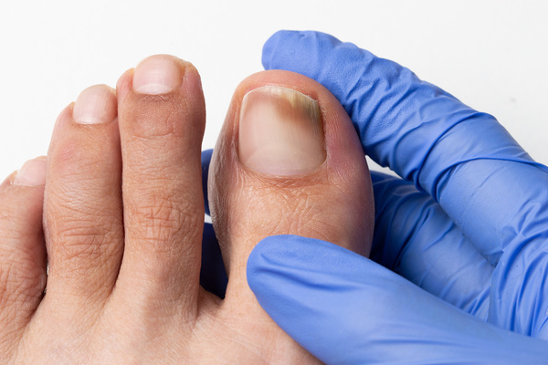 How to Prevent and Treat Nail Fungus 