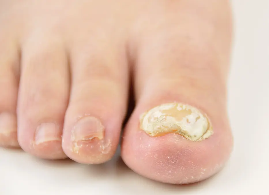 How to Prevent and Treat Nail Fungus 