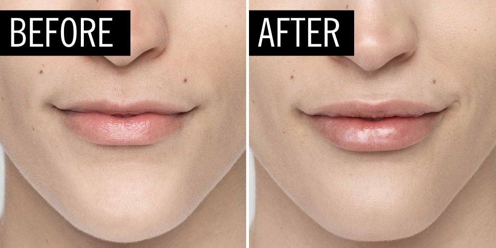 Lip Fillers 101: What to Expect and How to Maintain