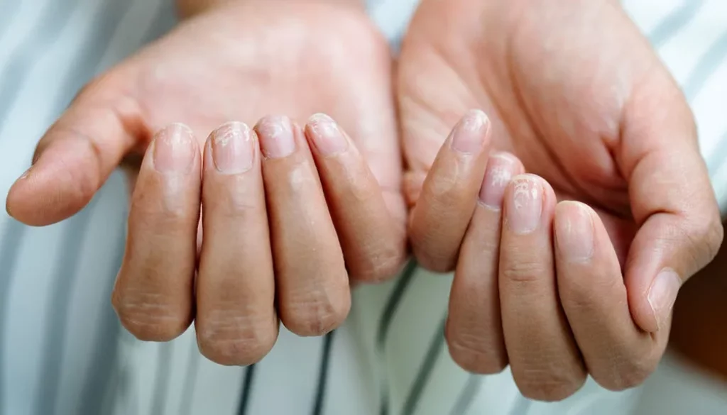 The Connection Between Diet and Nail Health